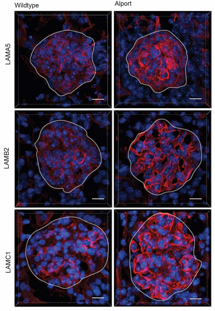 Microscopy images of the kidney filter in a healthy mouse (left) and a mouse with Alport syndrome (right).