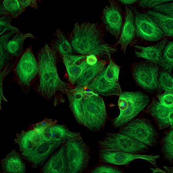 Cancer cells imaged with a fluorescence microscope