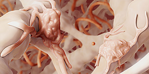 Parkinson's disease. 3D illustration showing neurons containing Lewy bodies.