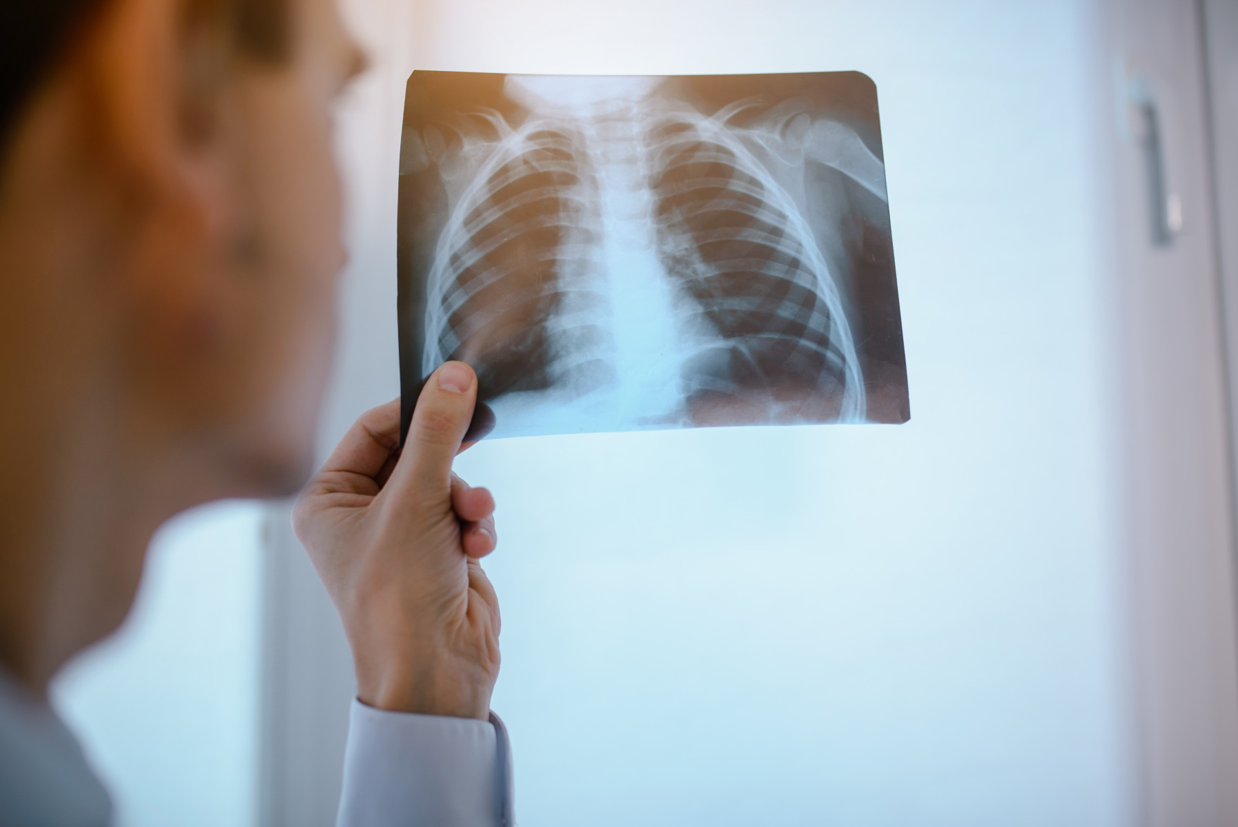 Lung X-ray Image