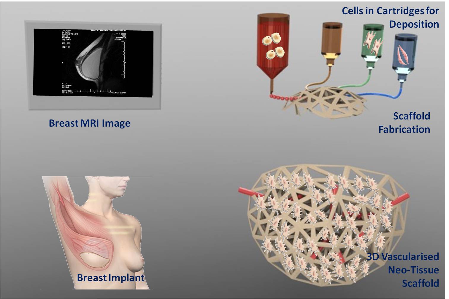 Breast implant system for 3D bioprinting
