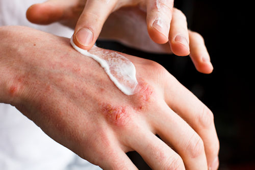 Why report to EPIDERM?